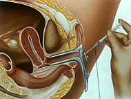 Insemination - K�nstliche Befruchtung