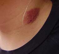 Typisches Merkmal das beim  Necking entstehen kann - der Knutschfleck.