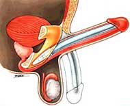 Biegsame Penisprothese