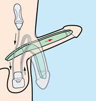 Hydraulisches Schwellk�rperimplantat
